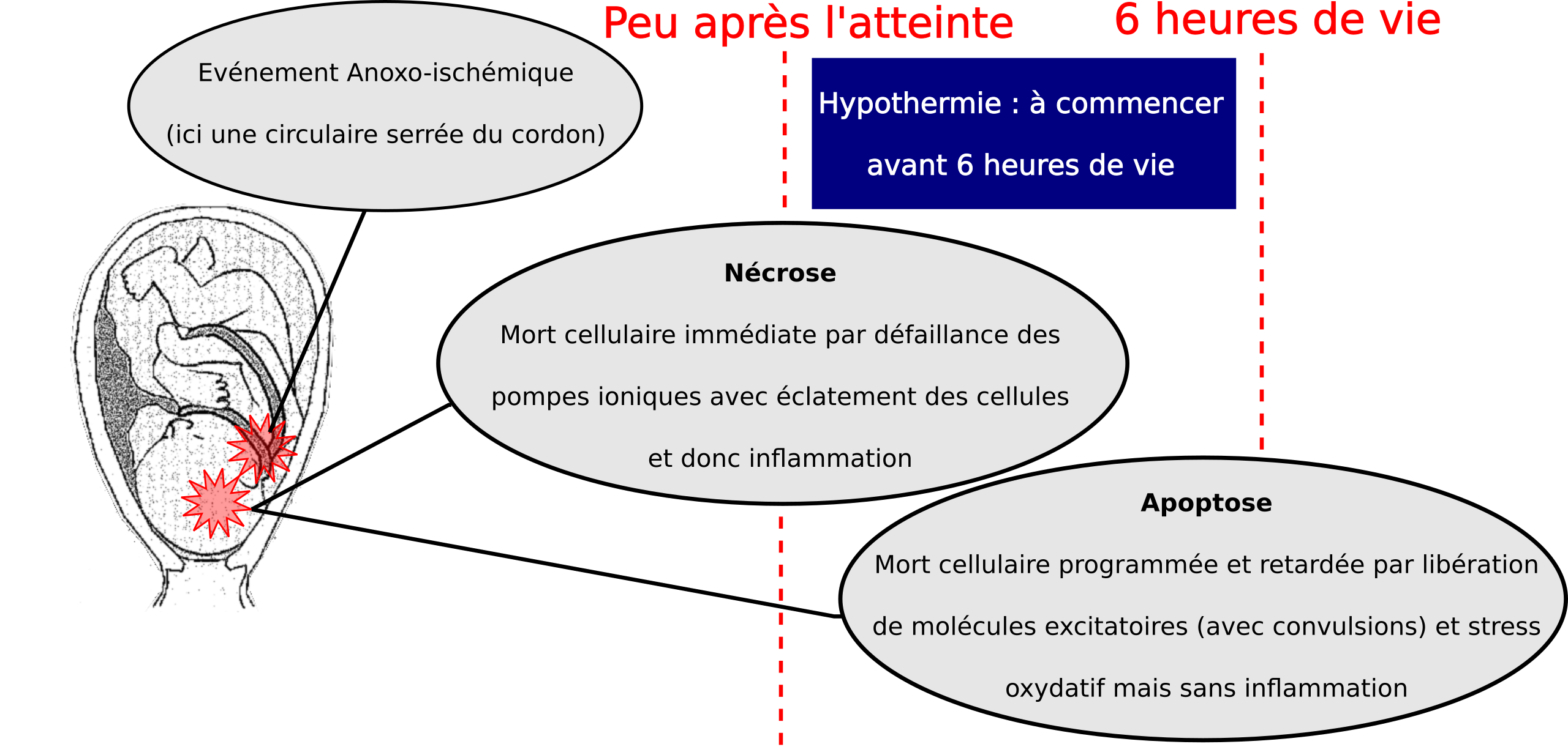 hypothermie néonatale pour un manque d'oxygène